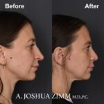 5 Revision Rhinoplasty 3