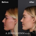 5 Rhinoplasty Before And After 1 1