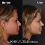 5 Rhinoplasty Before And After 1