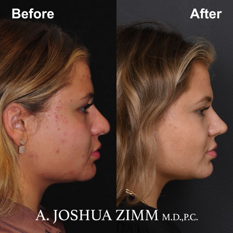 5 Rhinoplasty Before And After 1