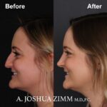 5 Rhinoplasty Before And After 10