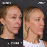 5 Rhinoplasty Before And After 13