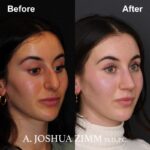 5 Rhinoplasty Before And After 15