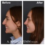 5 Rhinoplasty Before And After 16