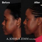 5 Rhinoplasty Before And After 17