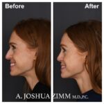 5 Rhinoplasty Before And After 20
