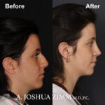 5 Rhinoplasty Before And After 21