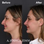 5 Rhinoplasty Before And After 22