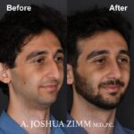 5 Rhinoplasty Before And After 24