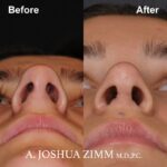 5 Rhinoplasty Before And After 25