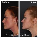 5 Rhinoplasty Before And After 27