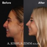 5 Rhinoplasty Before And After 28