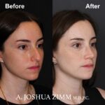 5 Rhinoplasty Before And After 29