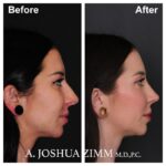 5 Rhinoplasty Before And After 30