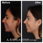 5 Rhinoplasty Before And After 33