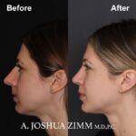 5 Rhinoplasty Before And After 36