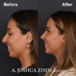 5 Rhinoplasty Before And After 38