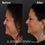 5 Rhinoplasty Before And After 4