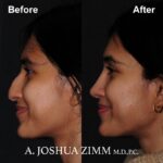 5 Rhinoplasty Before And After 40