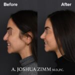 5 Rhinoplasty Before And After 43