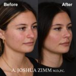5 Rhinoplasty Before And After 44