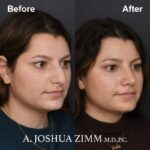 5 Rhinoplasty Before And After 45
