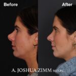 5 Rhinoplasty Before And After 46