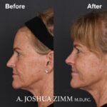 5 Rhinoplasty Before And After 48