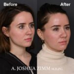 5 Rhinoplasty Before And After 49