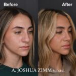 5 Rhinoplasty Before And After 5
