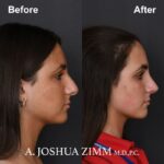 5 Rhinoplasty Before And After 51