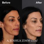 5 Rhinoplasty Before And After 52