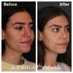 5 Rhinoplasty Before And After 53