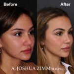 5 Rhinoplasty Before And After 54