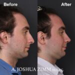 5 Rhinoplasty Before And After 56
