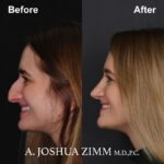 5 Rhinoplasty Before And After 57