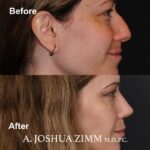 5 Rhinoplasty Before And After 58
