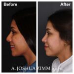 5 Rhinoplasty Before And After 61
