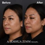 5 Rhinoplasty Before And After 7