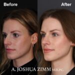 5 Rhinoplasty Before And After 8