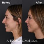 5 Rhinoplasty Before And After 9