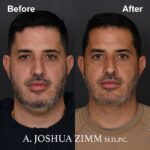 5.FaceTite AccuTite Before And After