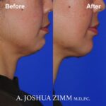 6 FaceTite AccuTite Before And Afte