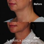 6 FaceTite AccuTite Before And After
