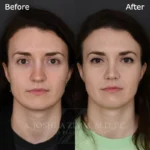 6 Mo FPNS