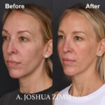 6 Chin Implant Before And After 1