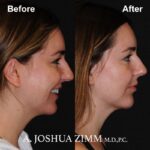 6 Chin Implant Before And After