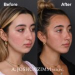 6 Chin Implant Before And After 2 1