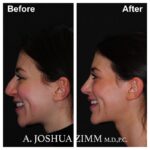 6 Chin Implant Before And After 2