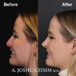 6 Revision Rhinoplasty 1